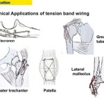 The Definitive Guide to Tension Band Wiring: Revolutionizing Fracture Stabilization