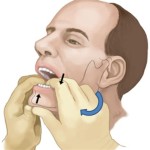Tips for Minimizing Pain During Jaw Wiring Removal